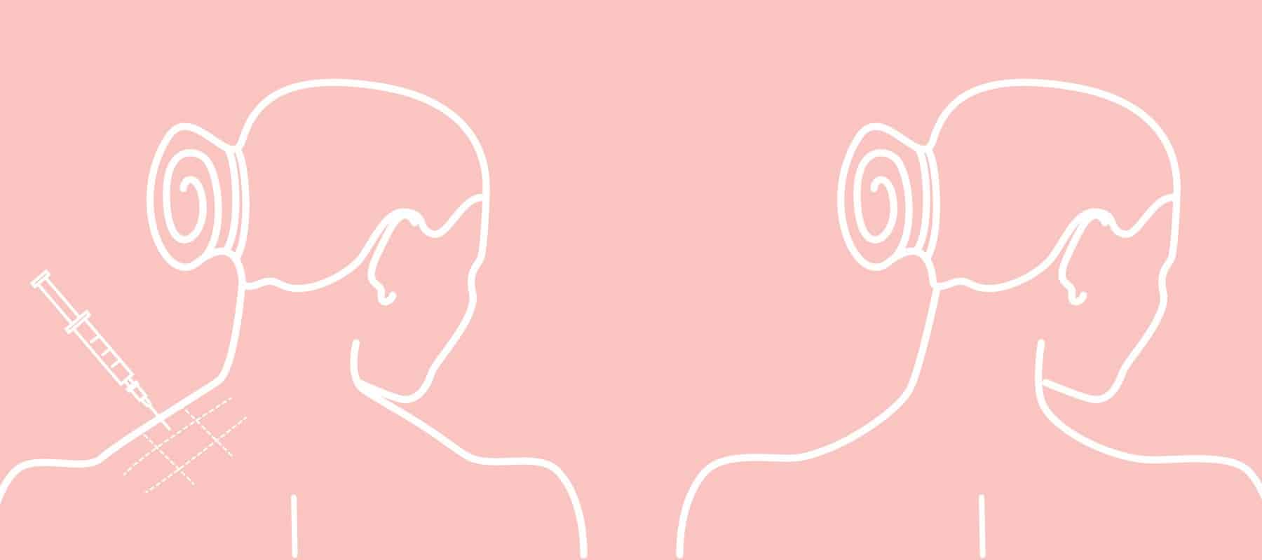 Botox Ergebnis natürlich subtil