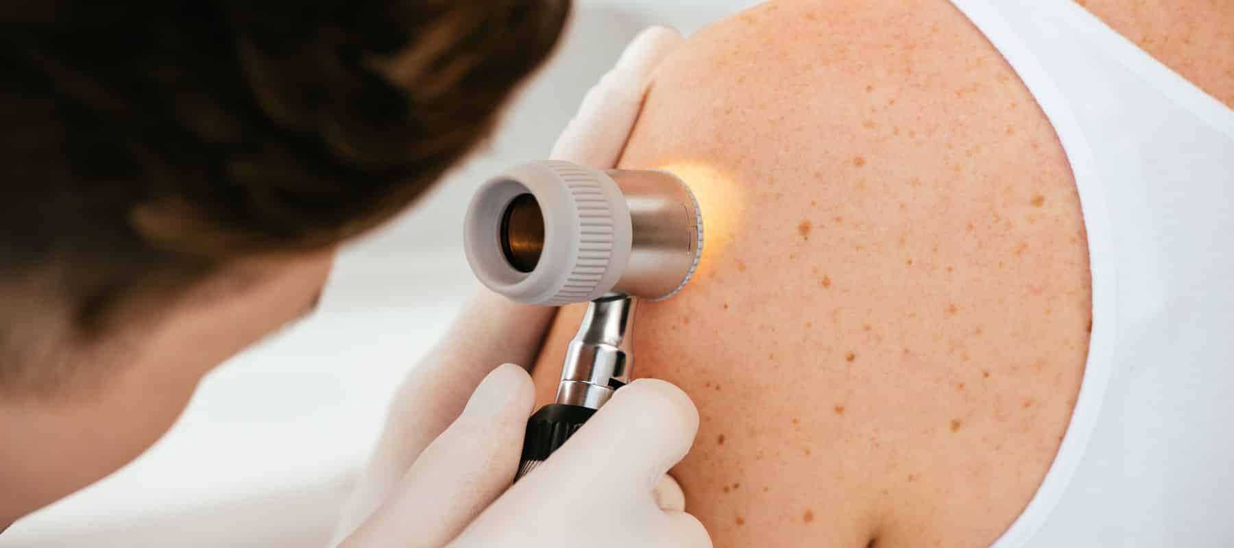 UV-Schutz und Prävention von schwarzem Hautkrebs