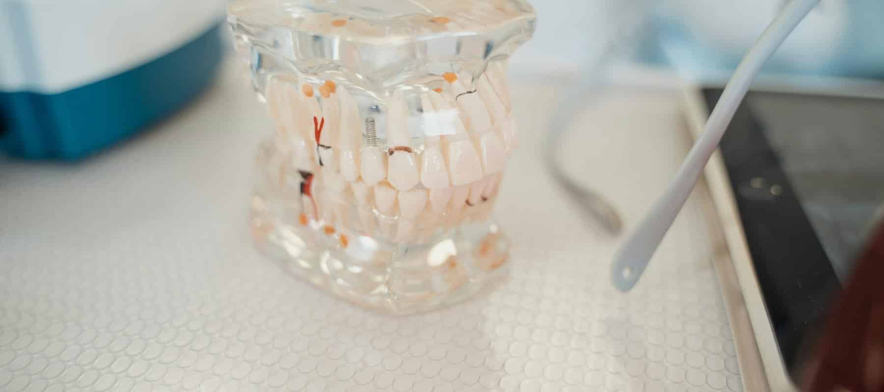 Zahnprothese - Verschiedene Arten von Zahnersatz