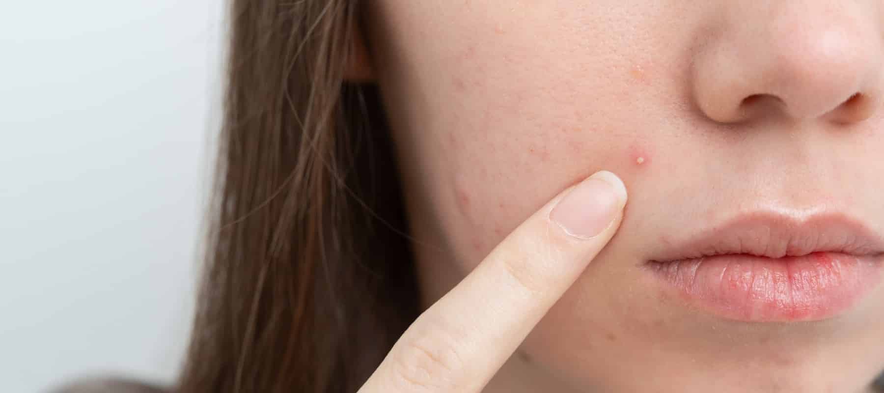 Azelainsäure Creme Gel Anwendung auf der Haut
