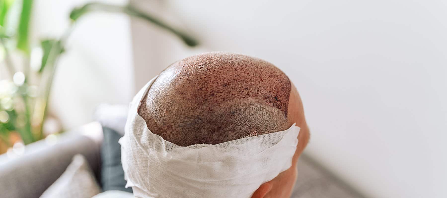 Haartransplantation Kosten