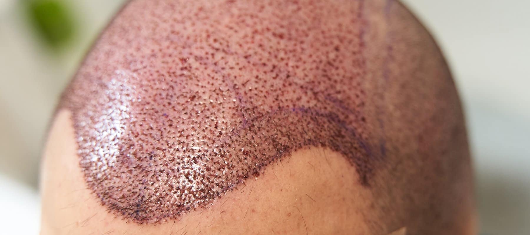 Haartransplantation Kosten