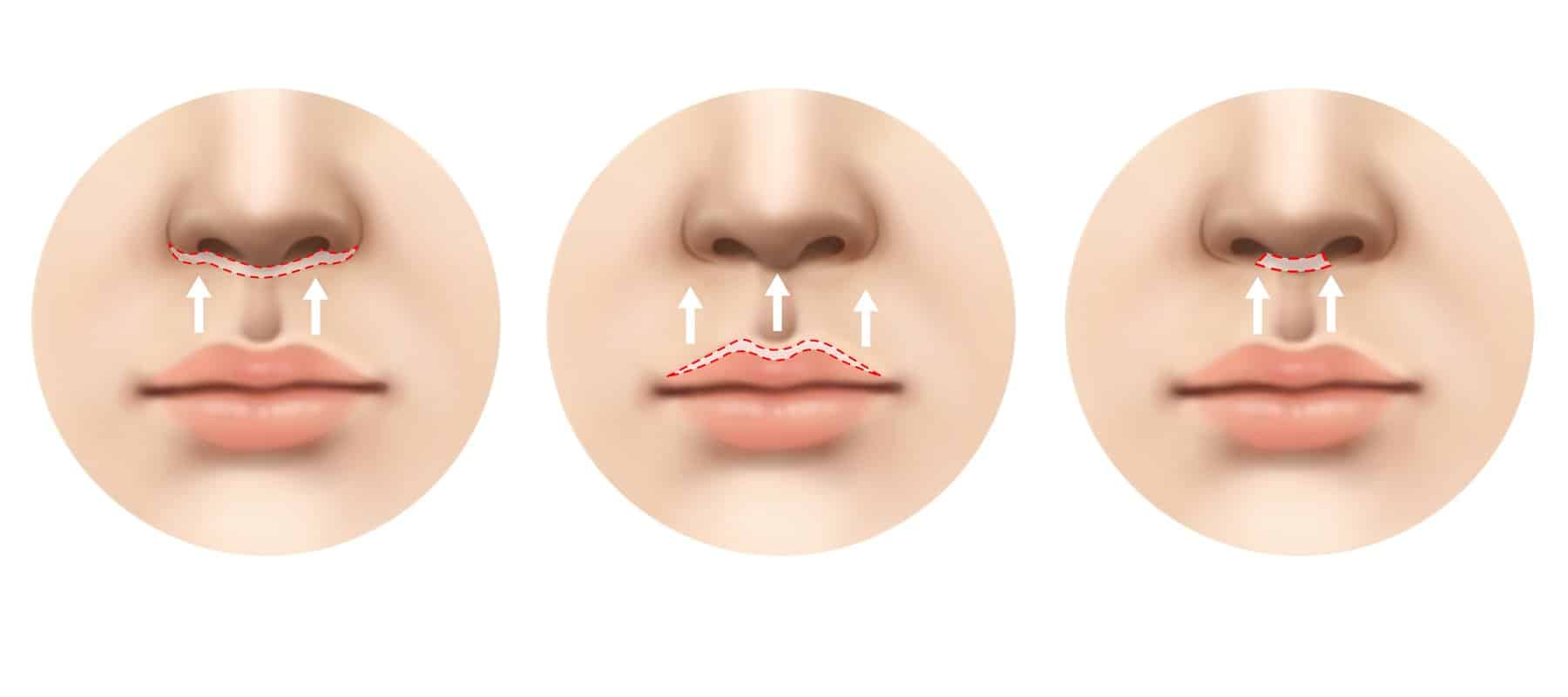 Lip Lift