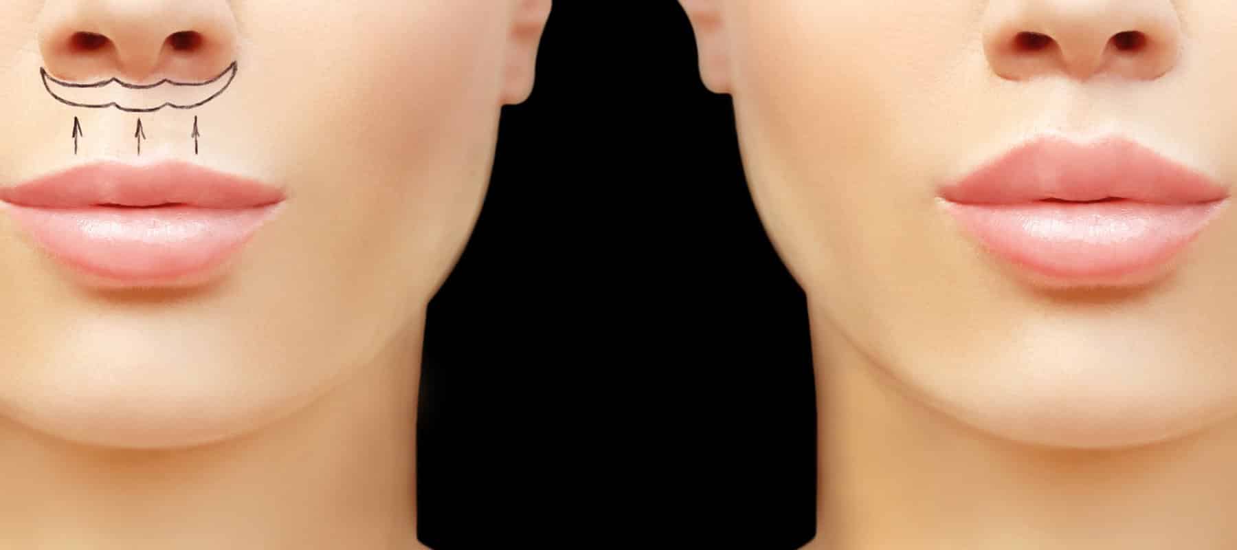 Lip Lift