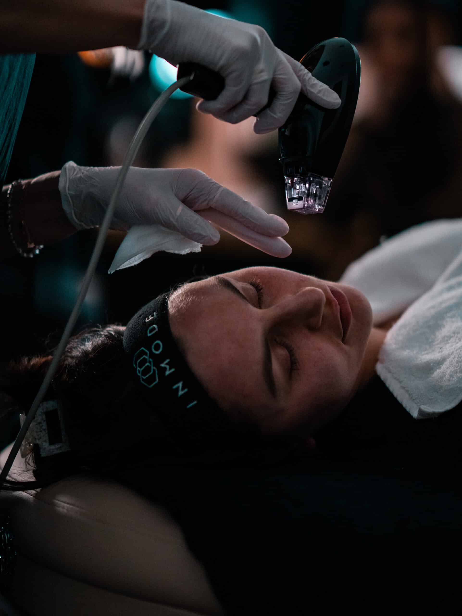 Morpheus8 Radiofrequenz-Microneedling Behandlung am Gesicht