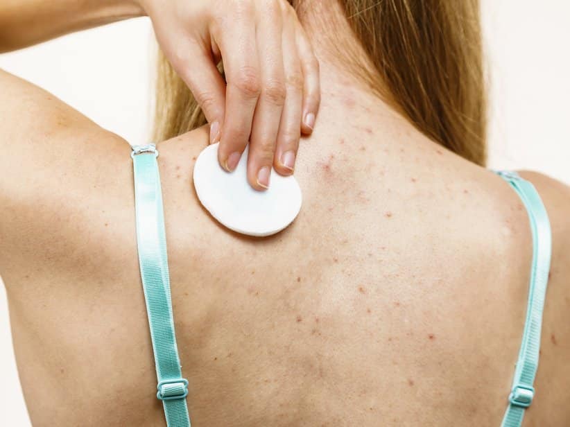 Hormonelle Akne – Arztgespräch zwischen Ärztin und Patientin, freundlich-professionell