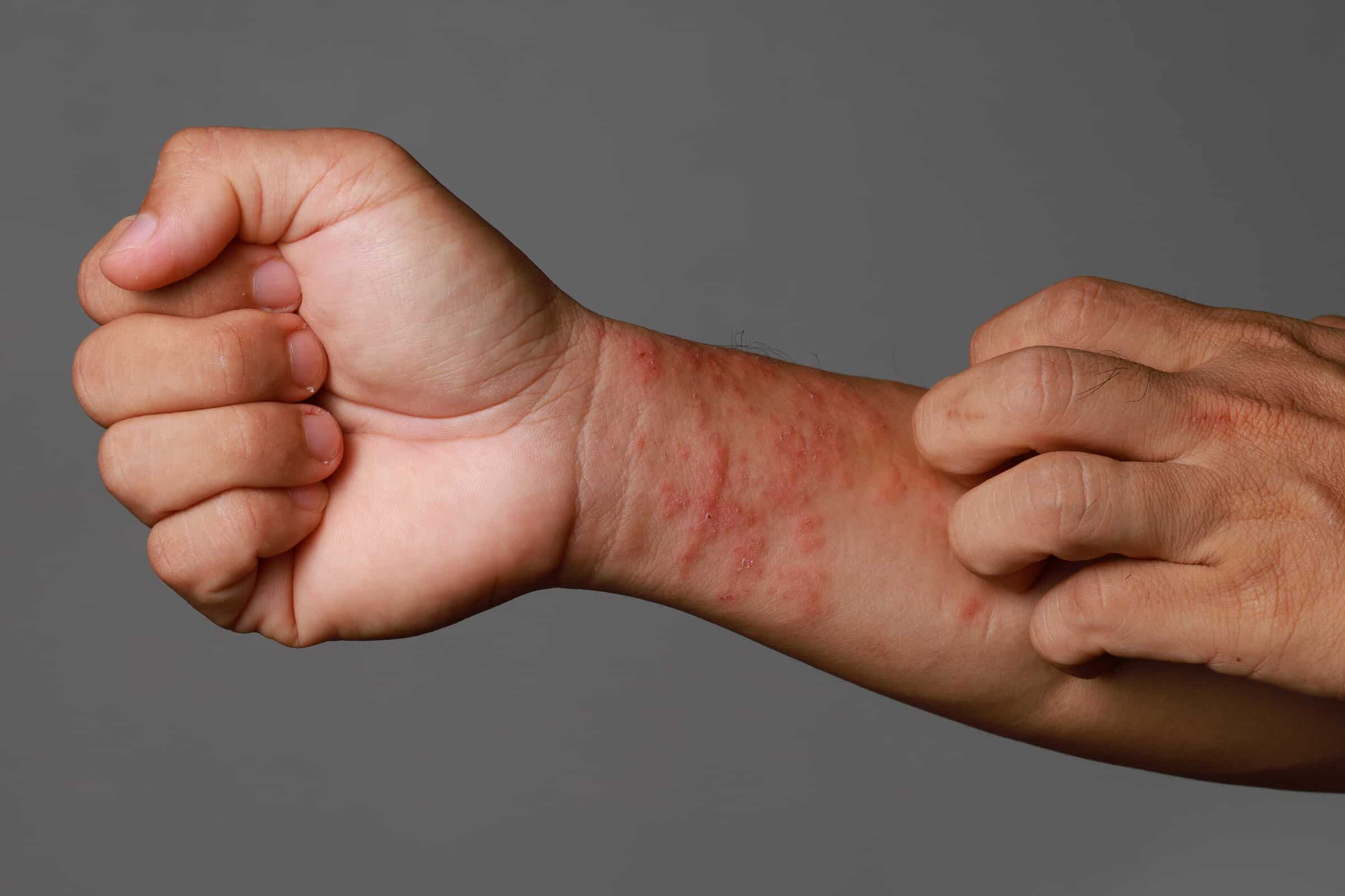 Allergischer Hautausschlag – Welche Kontaktallergene sind im Alltag besonders häufig