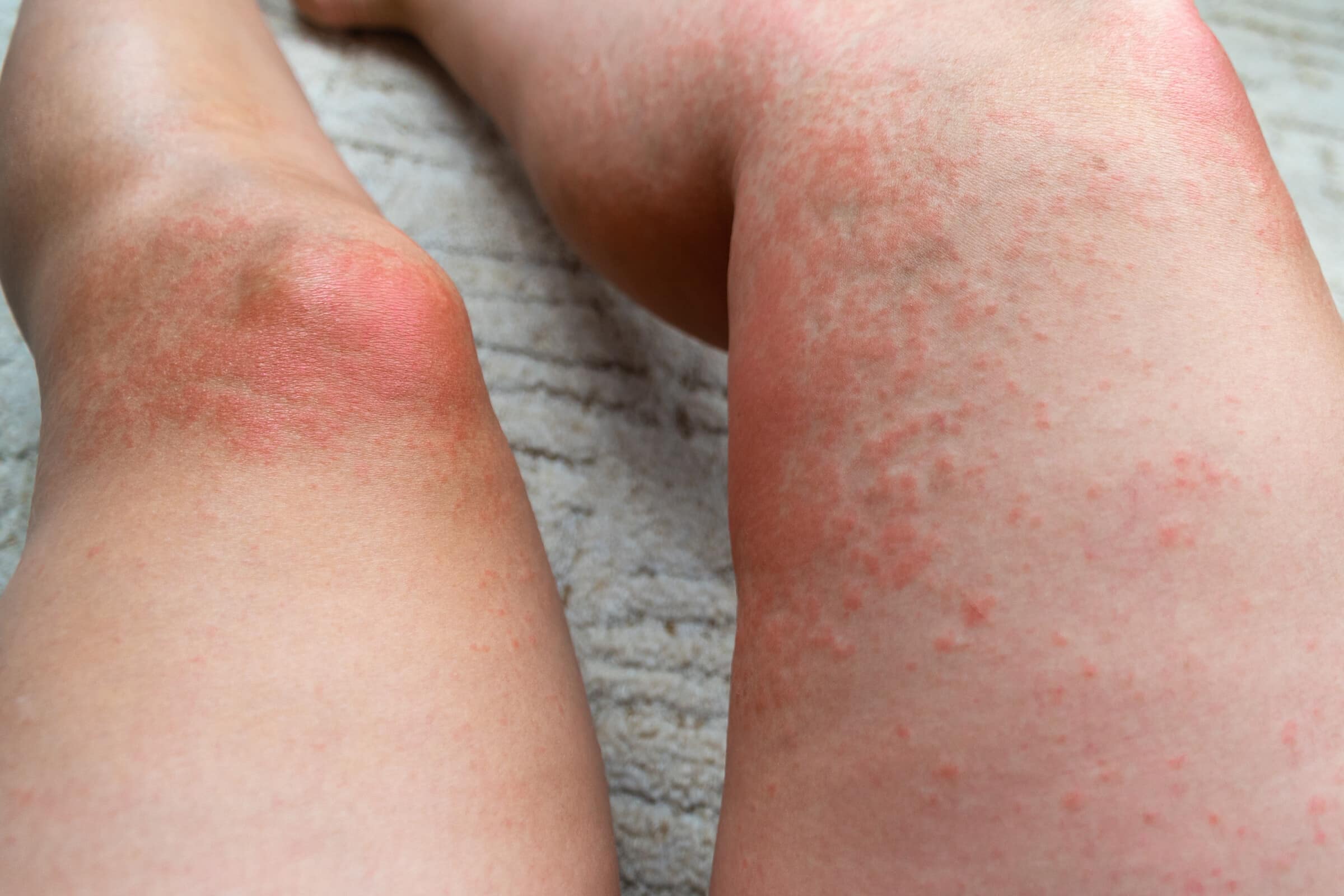 Allergischer Hautausschlag – Wie läuft ein Allergietest beim Arzt ab