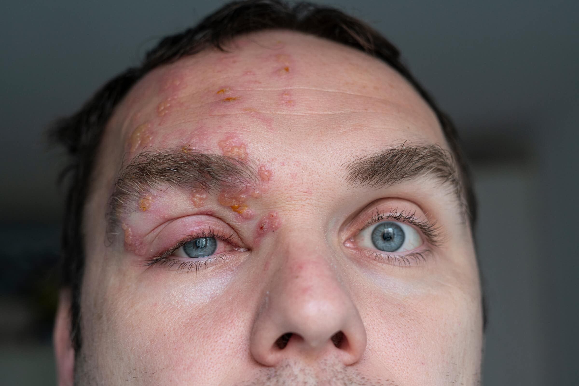 Augenherpes – Ist Augenherpes ansteckend