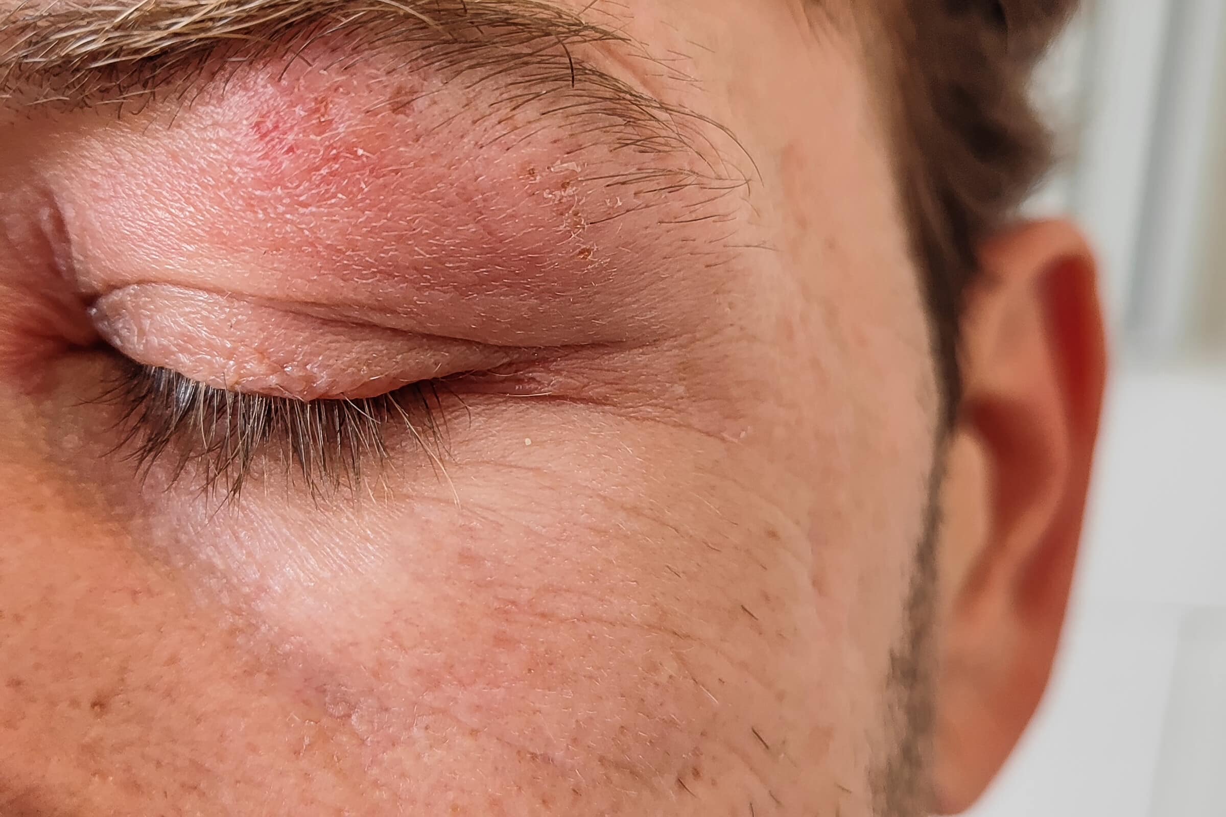 Augenherpes – Wie wird Augenherpes behandelt