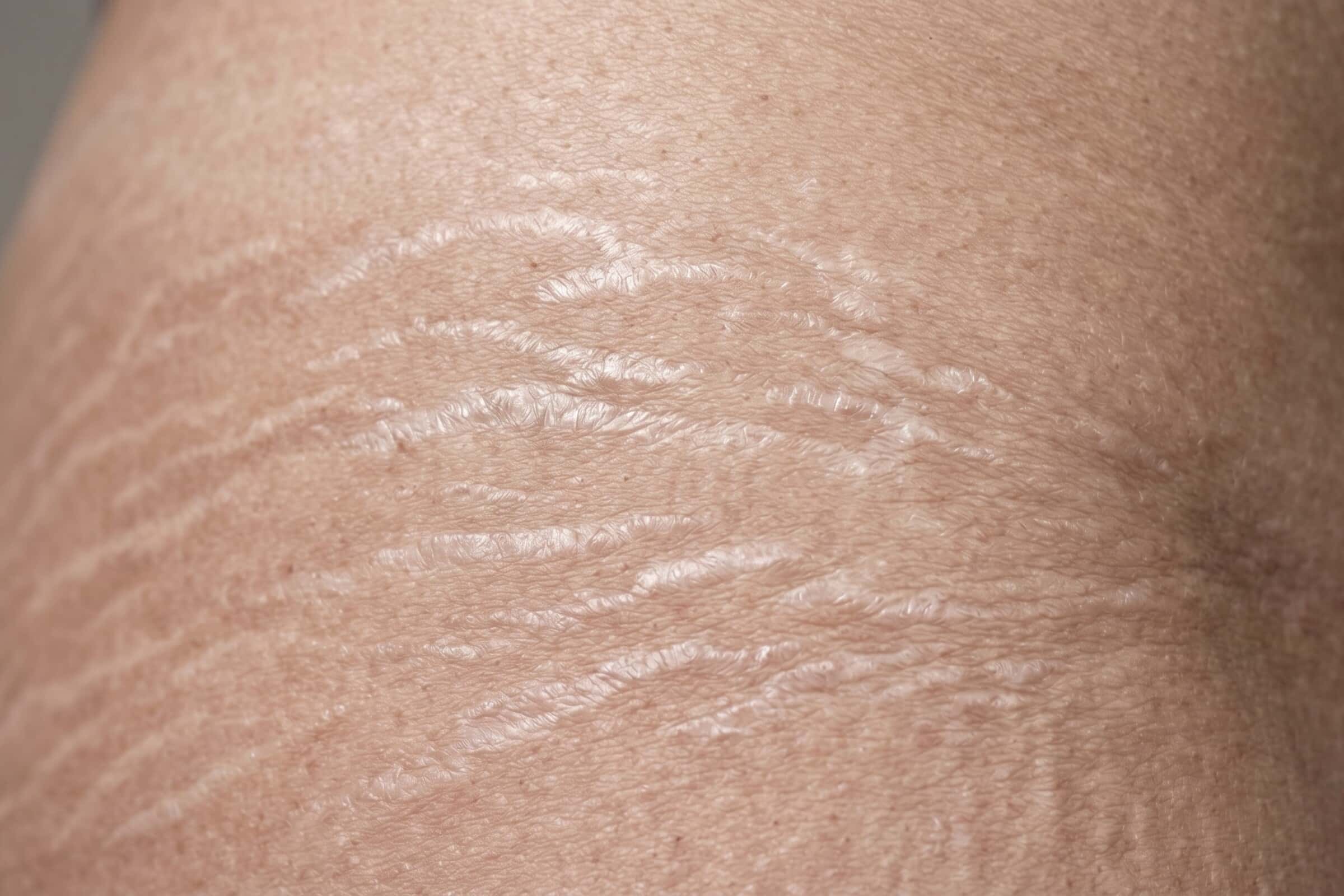 Bindegewebsschwäche – Wann sollte man einen Arzt aufsuchen