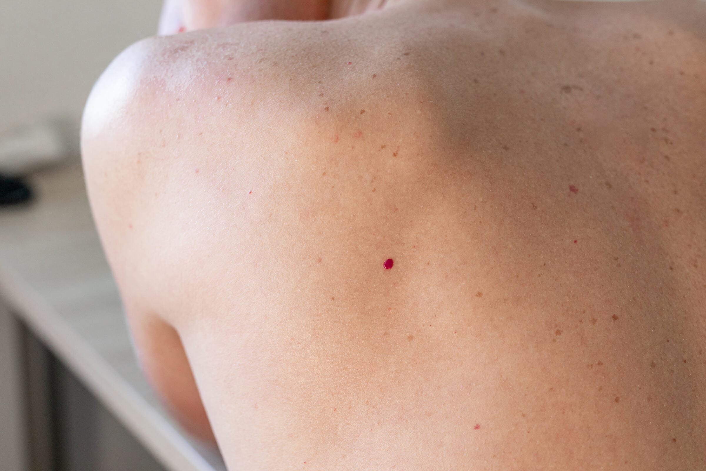 Kleine rote Punkte auf der Haut – Warum entstehen Kirschangiome und wer bekommt sie
