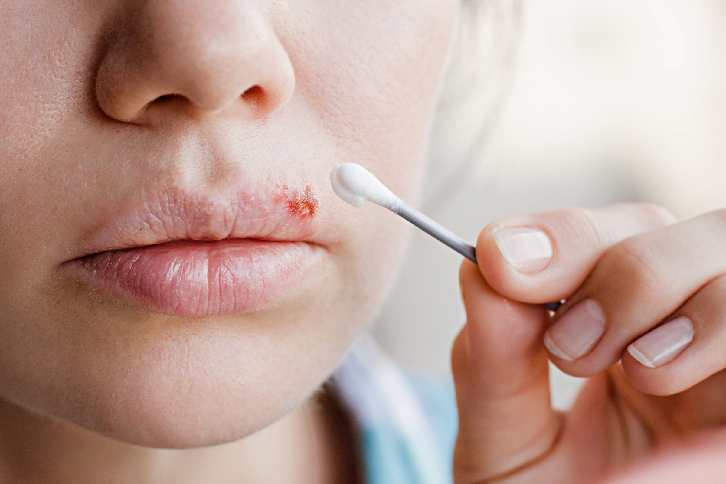 Lippenherpes – Wie sieht Lippenherpes aus und wie verläuft er