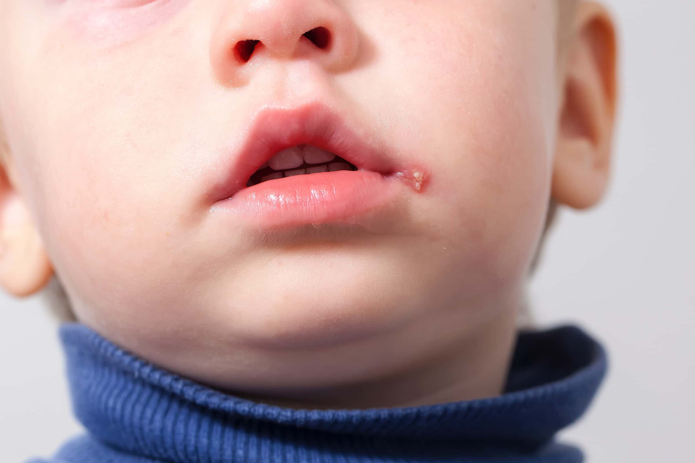 Lippenherpes – Was kostet die Behandlung von Lippenherpes