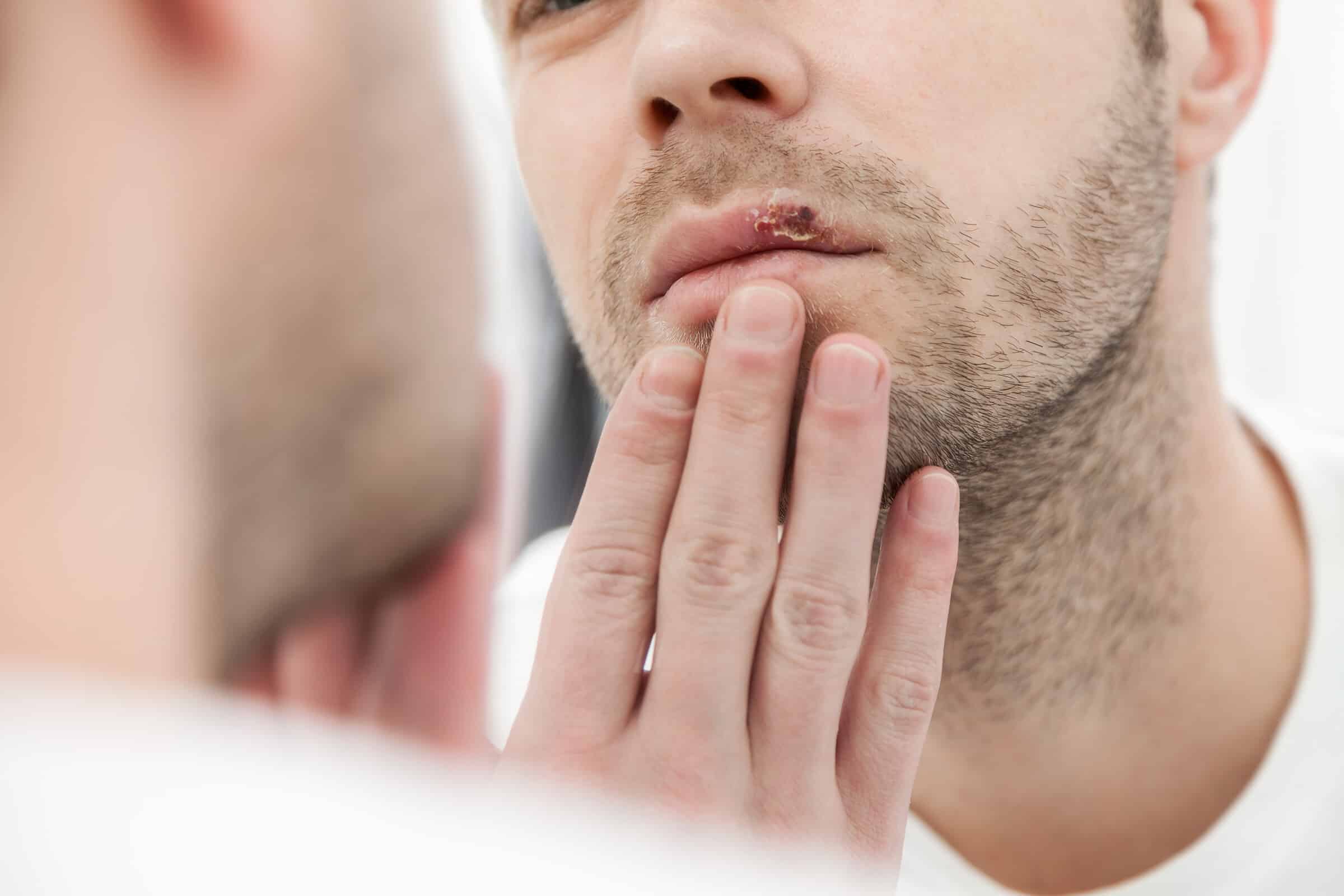 Lippenherpes – Wann sollte ich unbedingt zum Arzt