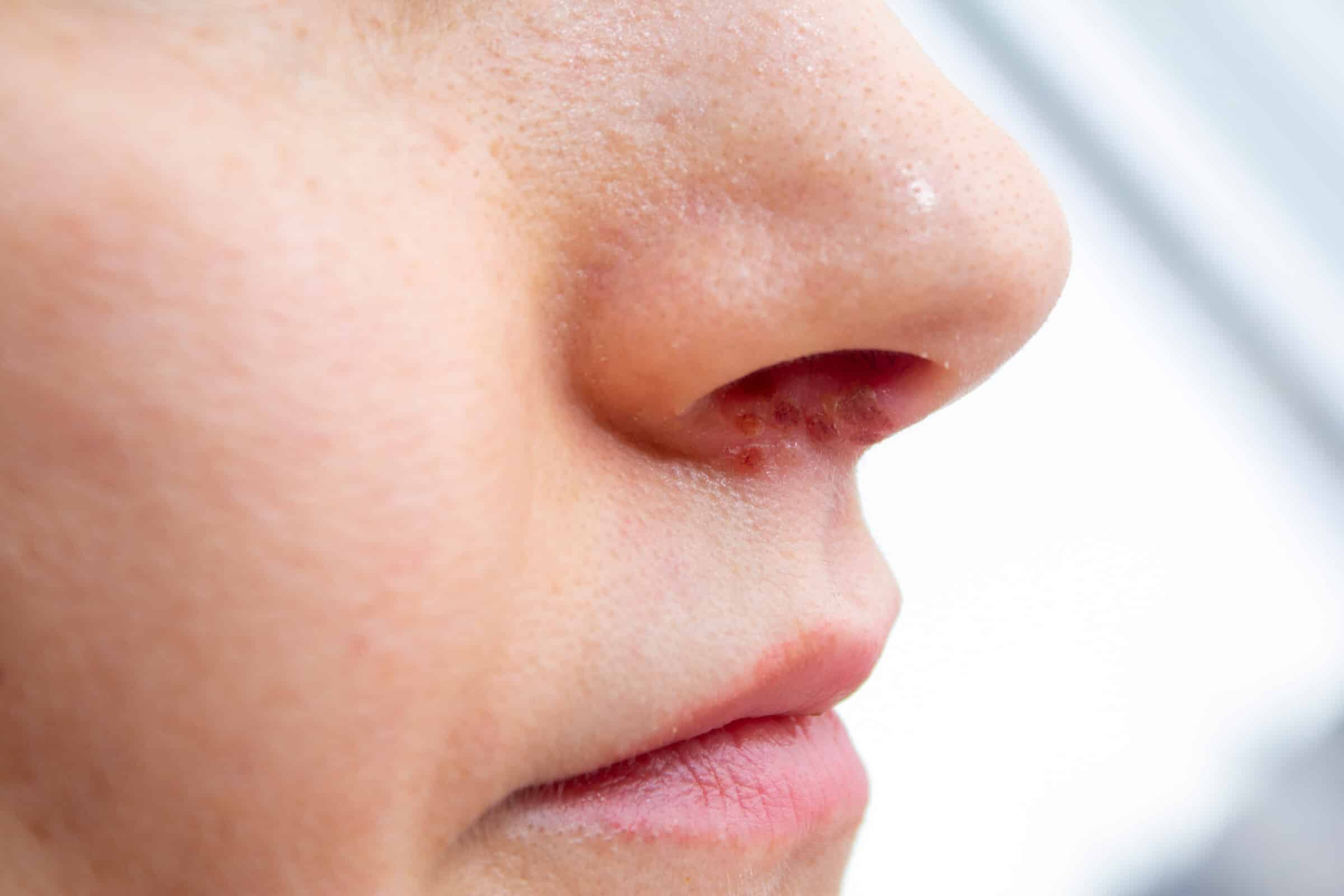 Nasenherpes – Wie steckt man sich mit Nasenherpes an