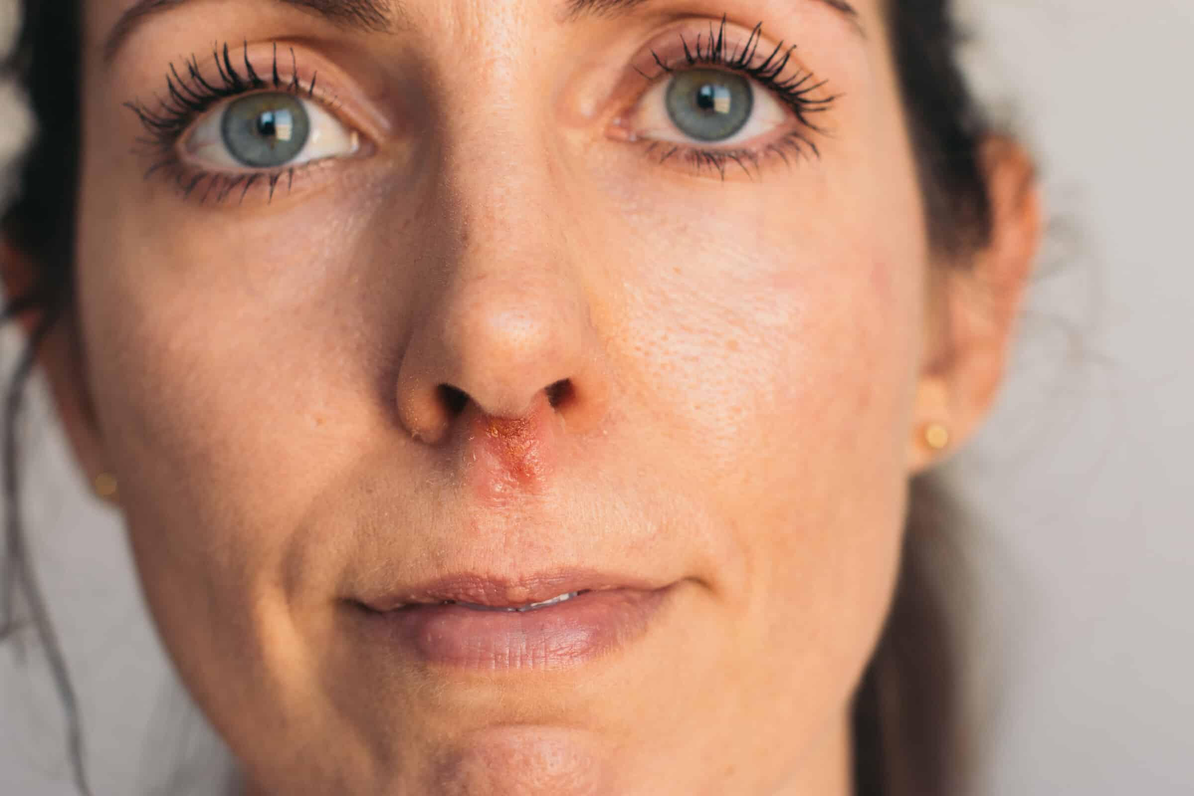 Nasenherpes – Was taugen Hausmittel gegen Nasenherpes