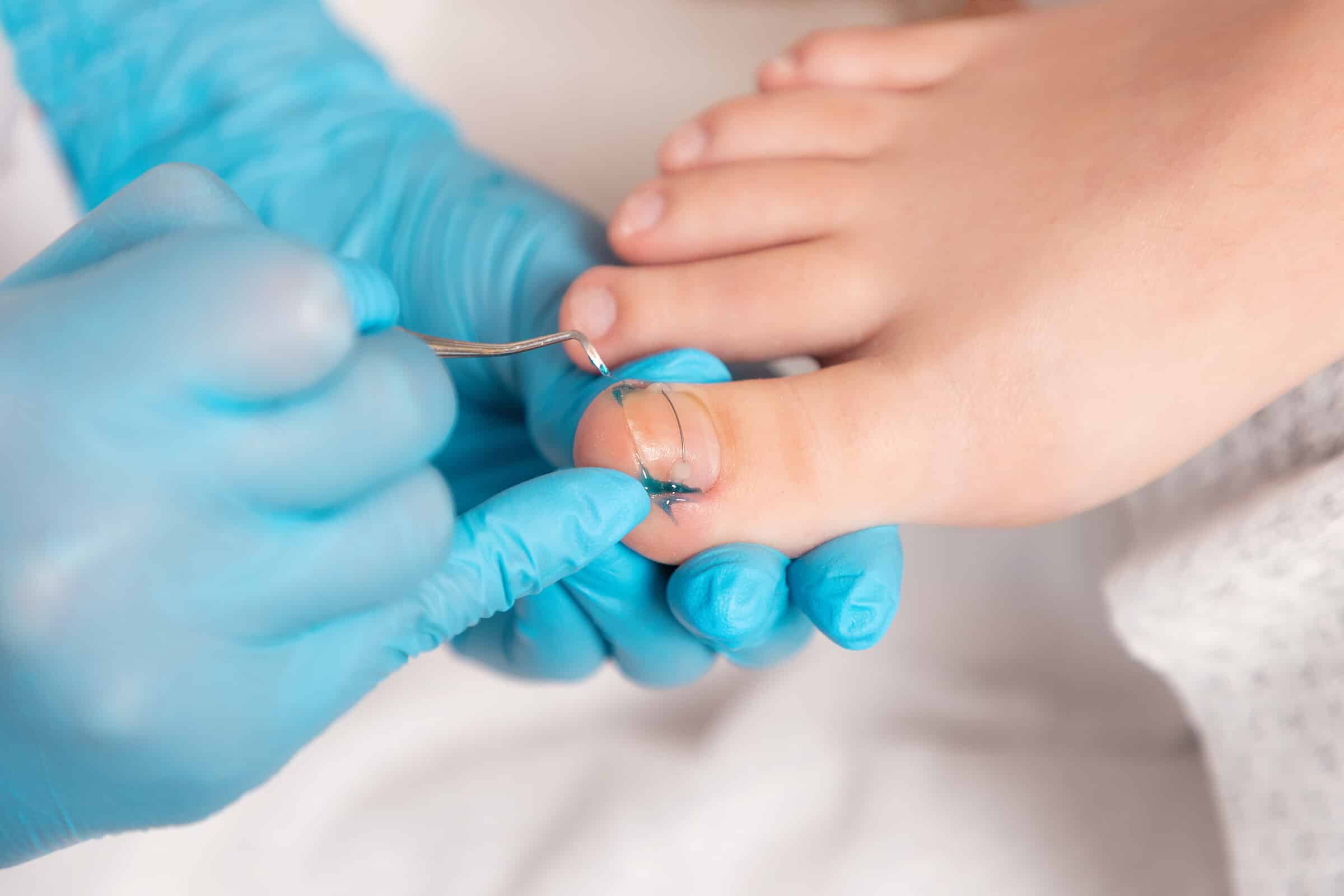 Behandlung eines eingewachsenen Nagels durch eine Fachkraft mit Handschuhen