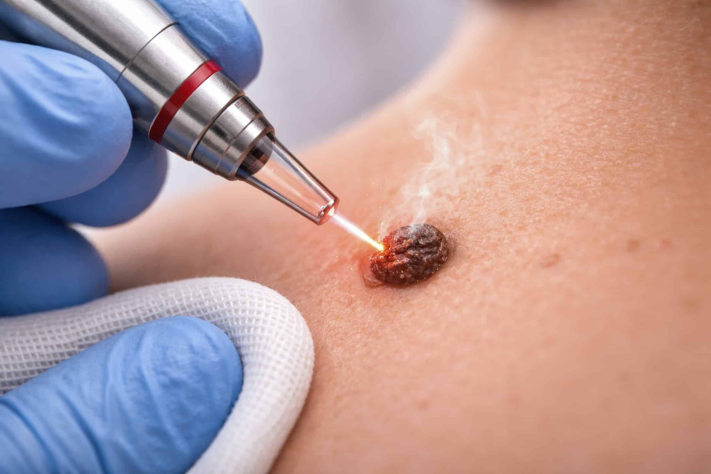 Stielwarzen (Fibrome) entfernen – Wie unterscheidet man Stielwarzen von anderen Hautveränderungen