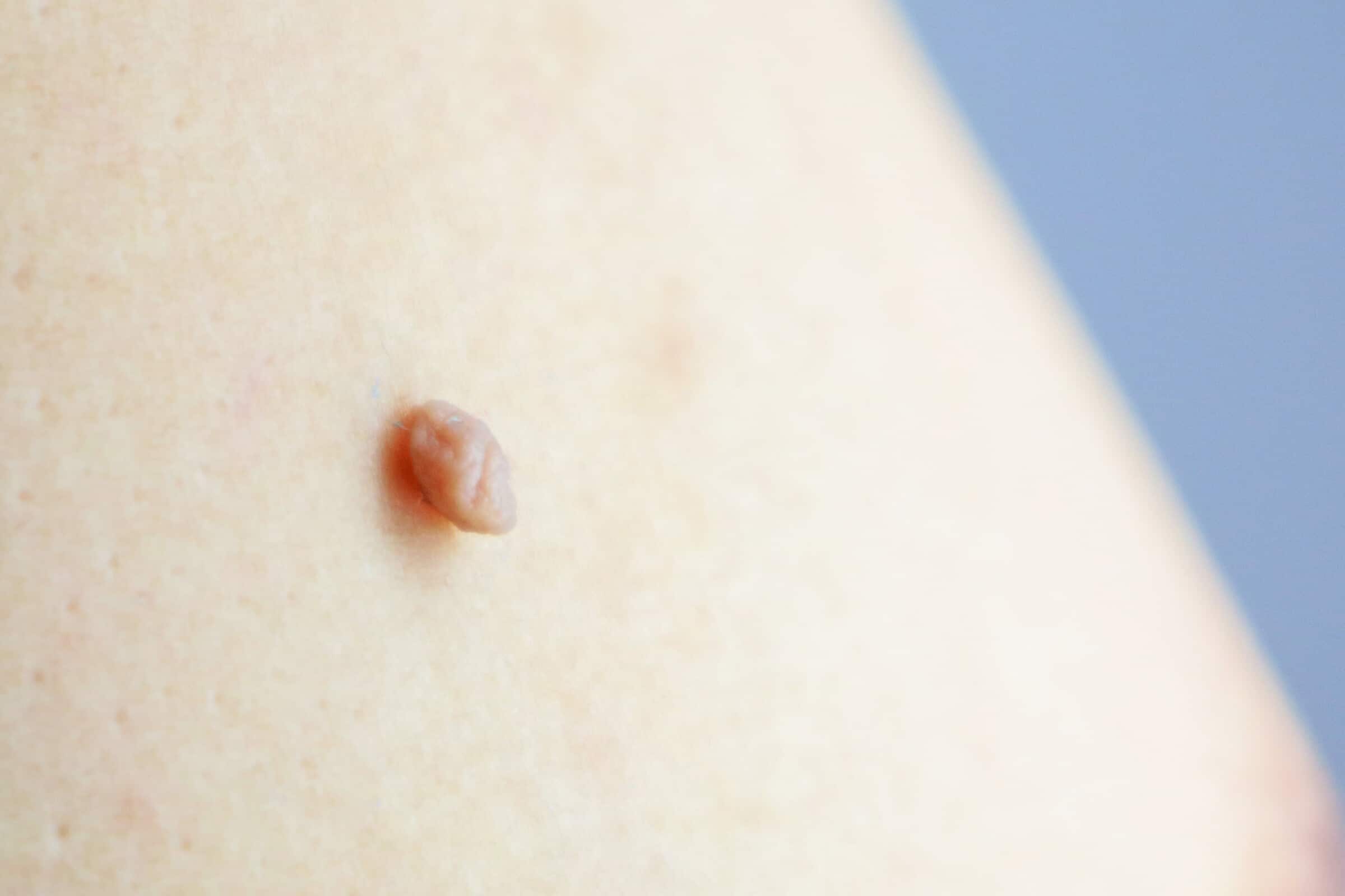 Stielwarzen (Fibrome) entfernen – Warum sollte man Stielwarzen nicht selbst entfernen