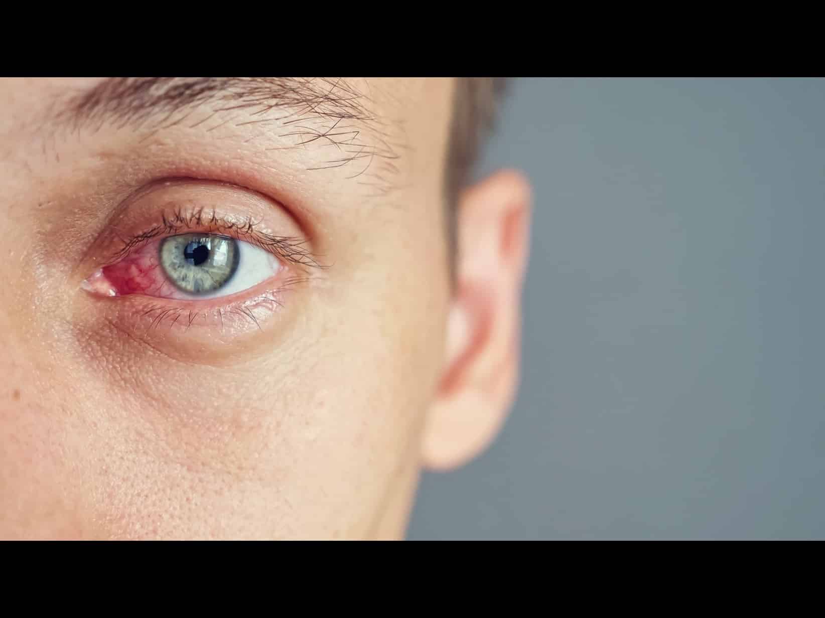 Nahaufnahme eines geröteten und gereizten Auges