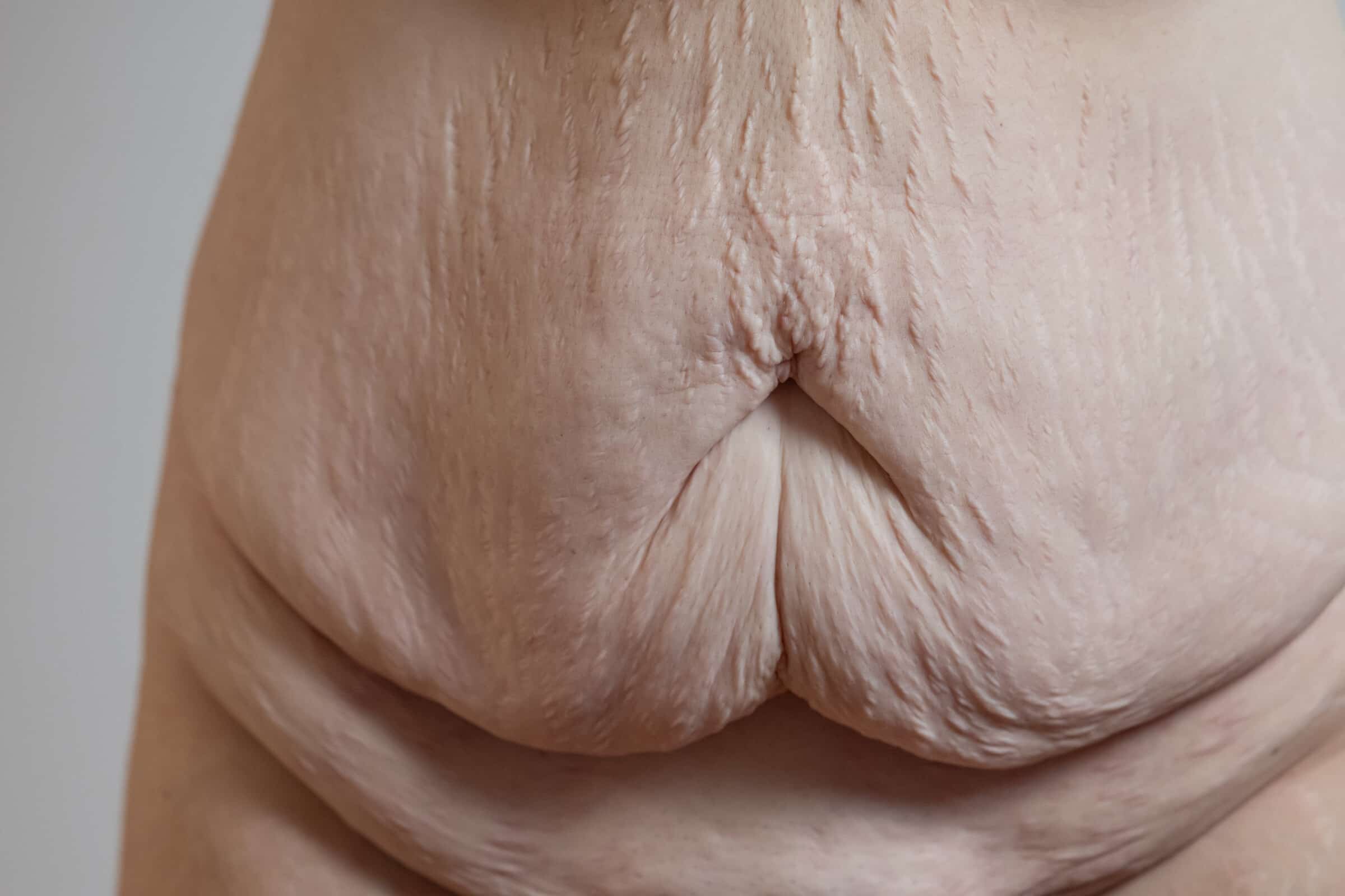 Plastischer Chirurg führt ein Bodylift durch