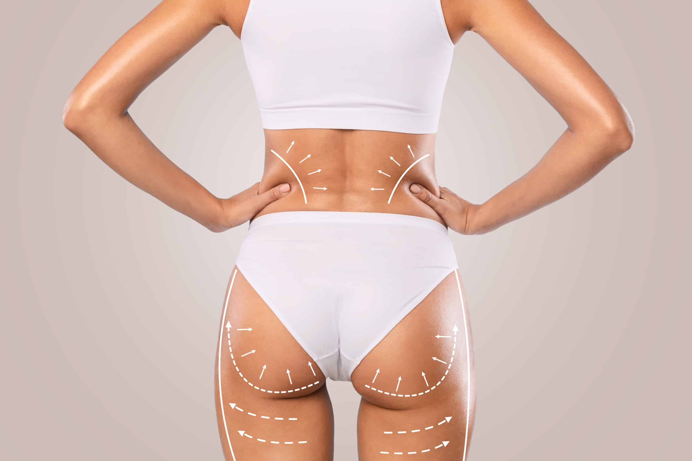 Gestraffte Körpermitte nach einem zirkulären Bodylift