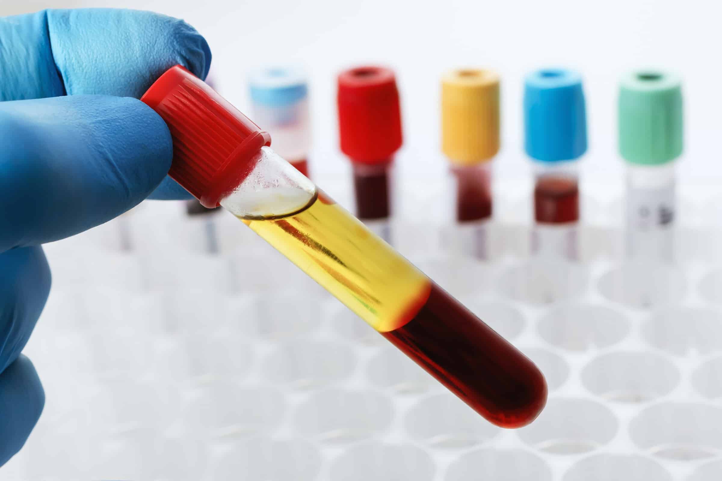 Medizinisches Gerät für die subdermale Plasma-Hautstraffung
