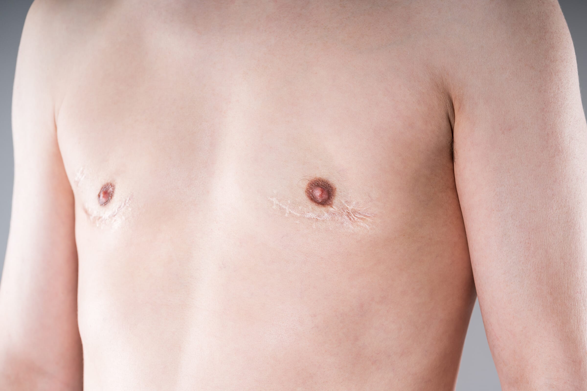 Kompressionsweste für die Nachsorge nach der Top Surgery