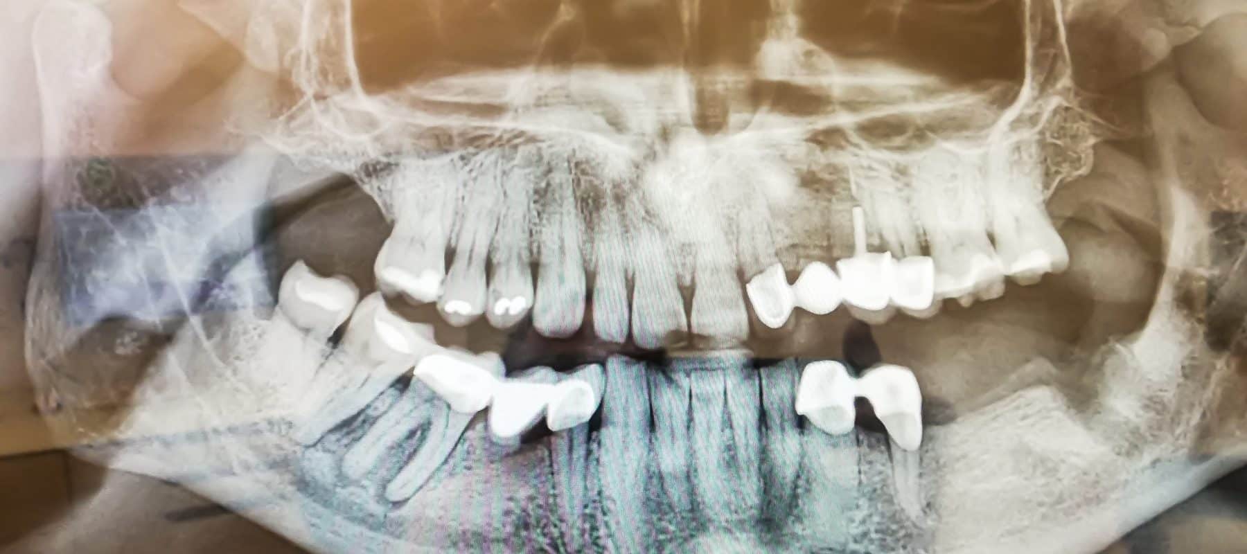 3D Röntgen DVT - Moderne Diagnostik beim Zahnarzt