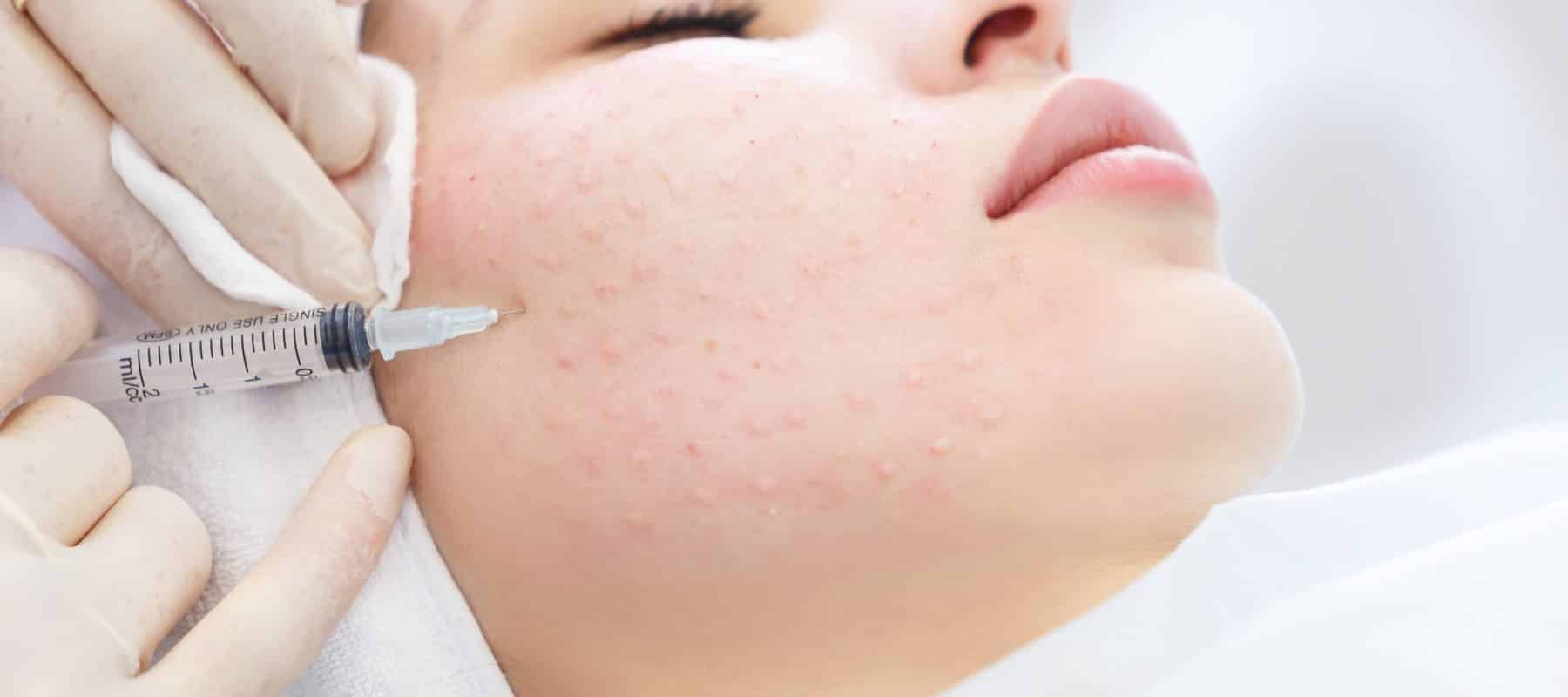 Exosomen-Injektion zur Hautverjüngung – ästhetische Behandlung