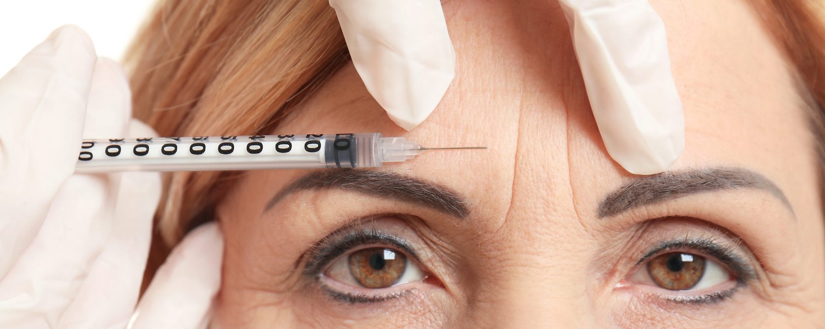 Hautalterung - Botulinumtoxin