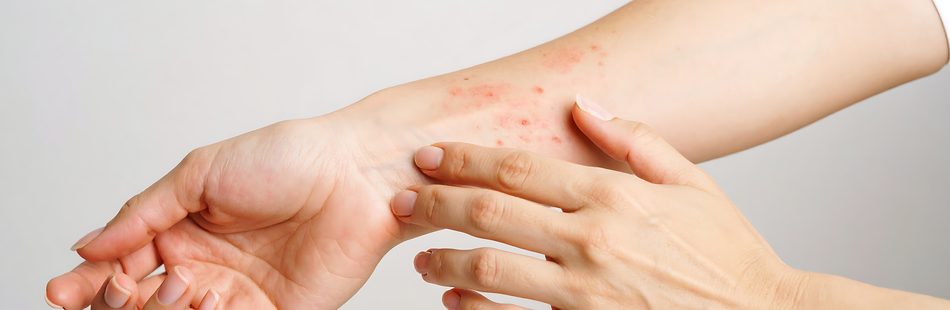 Dein Arzt kann Dir hierzu Salben, Cremes oder Medikamente zum Einnehmen verschreiben oder die Erkrankung mit Techniken wie Licht, Wärme und Kälte therapieren