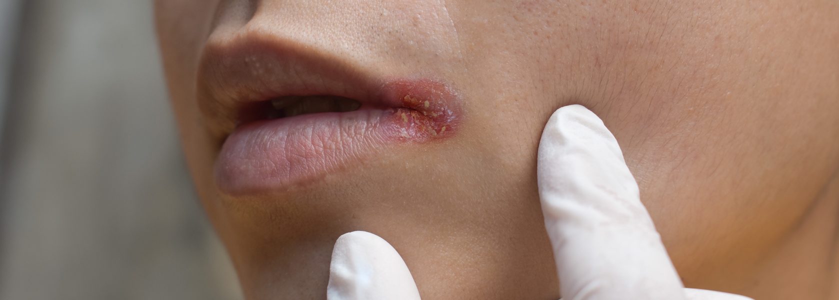 Herpes - Vermeide zu starke UV-Strahlung, extreme Hitze oder Kälte sowie Stress