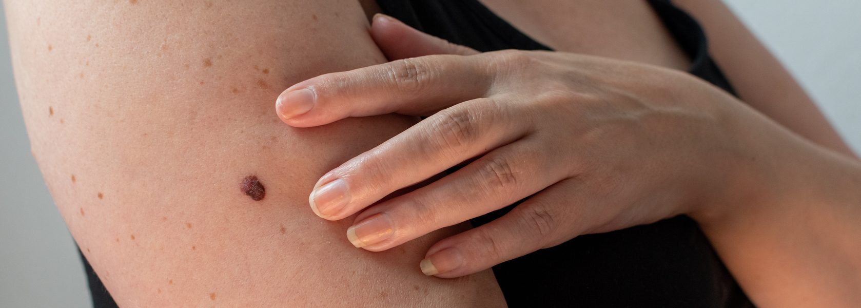 Keratosis Pilaris (Reibeisenhaut) - Was versteht die Medizin unter einer Keratosis Pilaris?