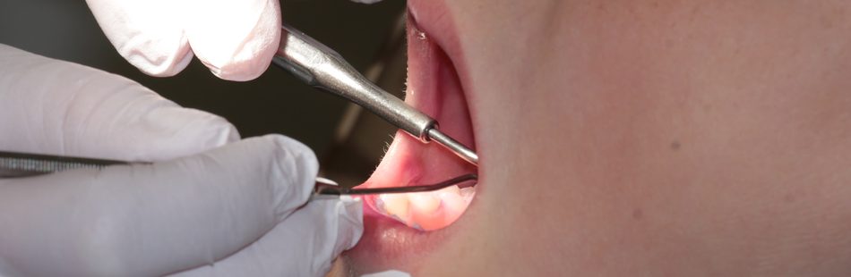 Die Behandlungsmöglichkeiten bei Kiferschmerzen sind unterschiedlich, da die eigentliche Urtsache der ausschlaggebende Faktor ist