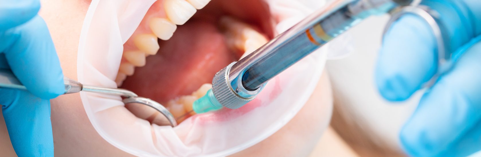 Leukoplakie - Chirurgische Entfernung