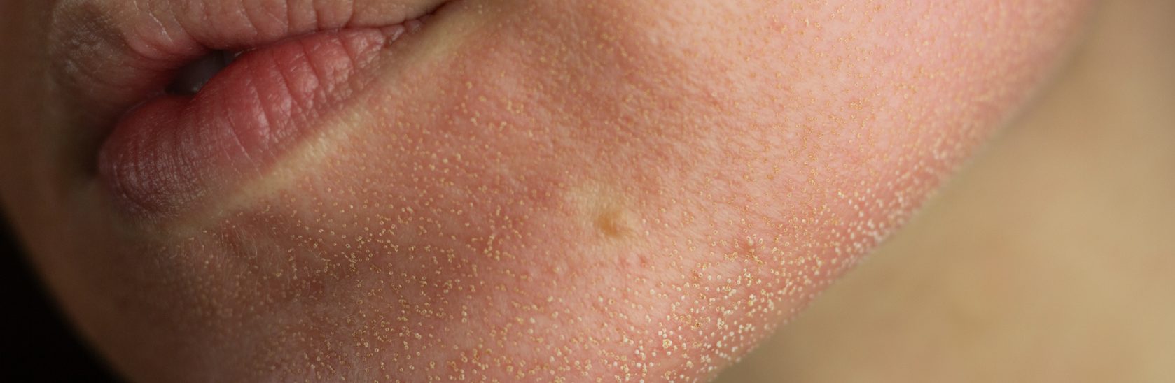 Pemphigus vulgaris - Was versteht die Medizin unter einem Pemphigus vulgaris?