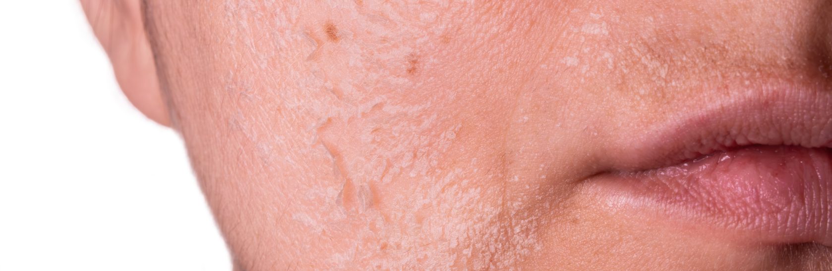 Rosacea - Welche Formen gibt es?