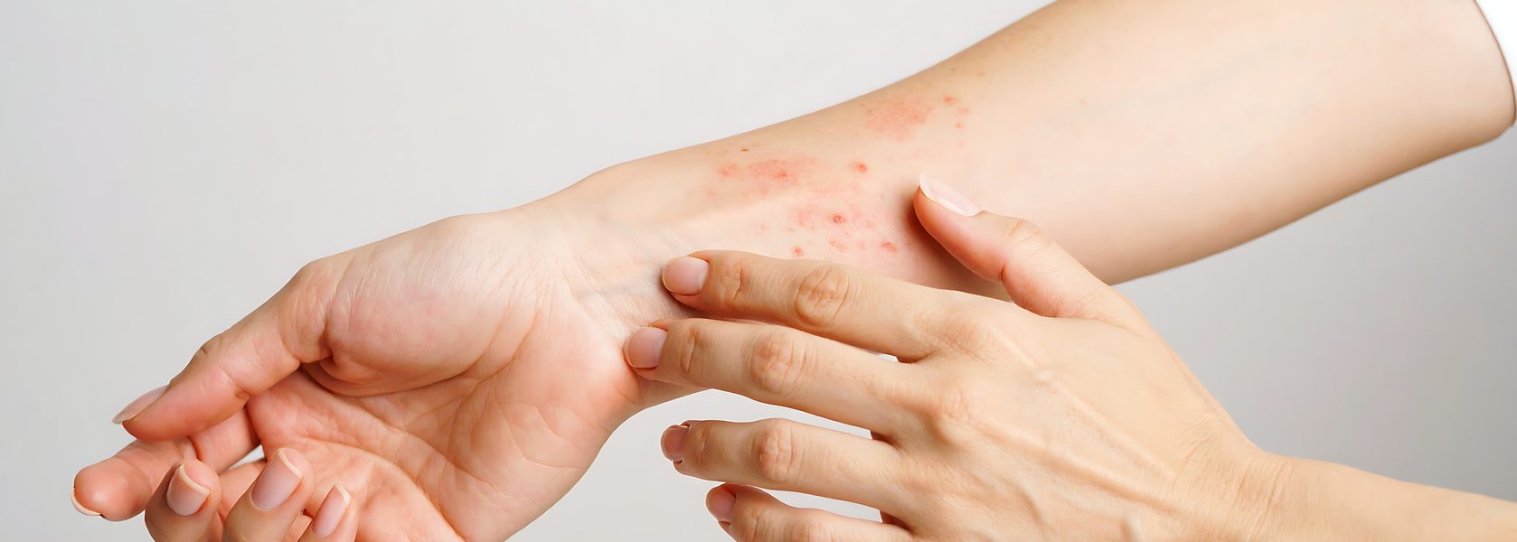Schuppenflechte (Psoriasis) - Was versteht die Medizin unter einer Schuppenflechte?