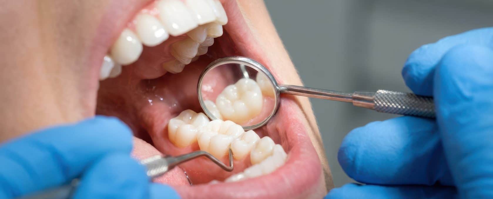 Zahnfleischbehandlung (Zahnfleischkorrektur) - Was ist eine Zahnfleischbehandlung?
