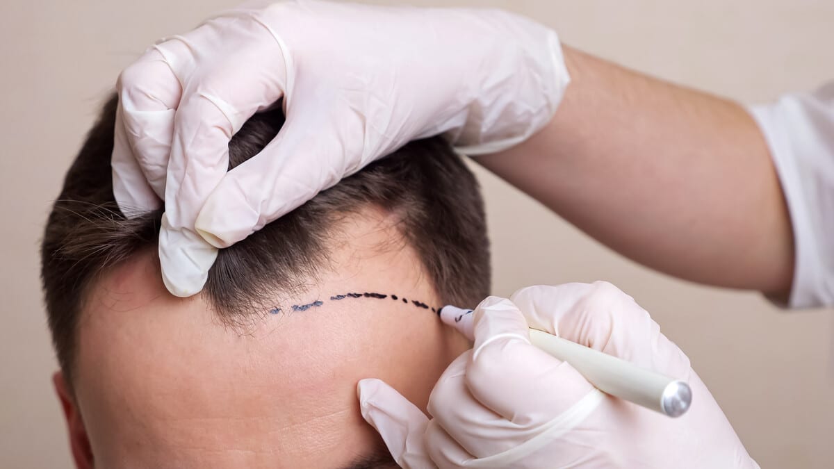 Haare klonen: Was hinter der Forschung und dem Follicle Banking steckt