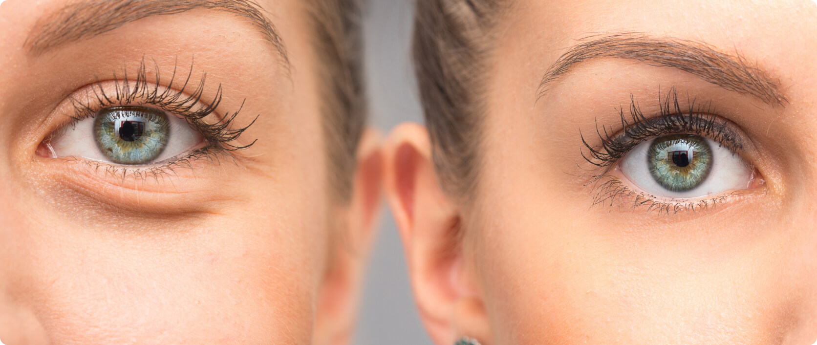 Augenringe entfernen - Was ist der Unterschied zwischen Augenringen und Tränensäcken?