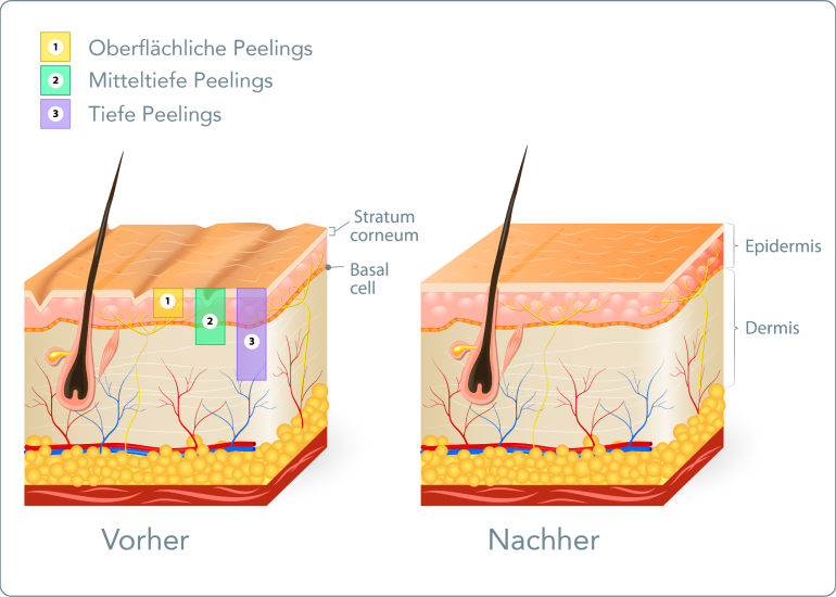 Chemisches Peeling - Wie läuft ein chemisches Peeling ab?