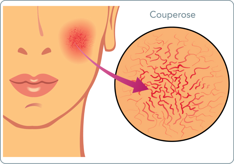 Couperose - Wie entsteht eine Couperose?