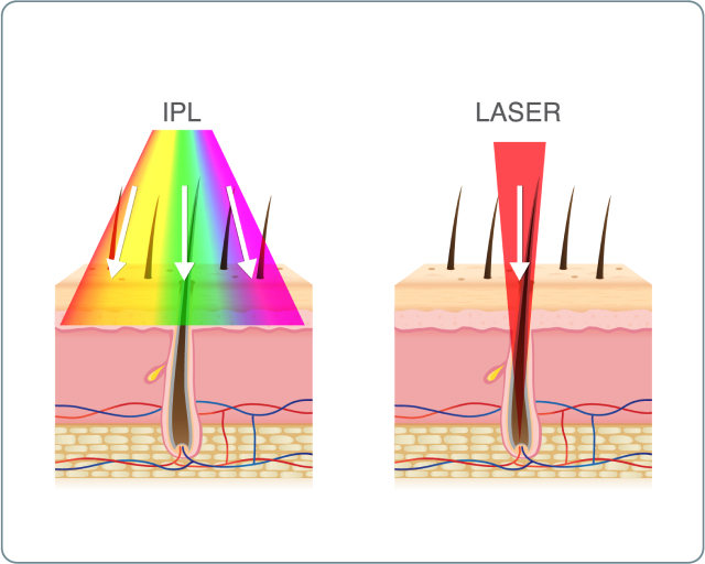Dauerhafte Haarentfernung - Haarentfernung durch IPL, SHR und HPL (Haarentfernung mit Licht)