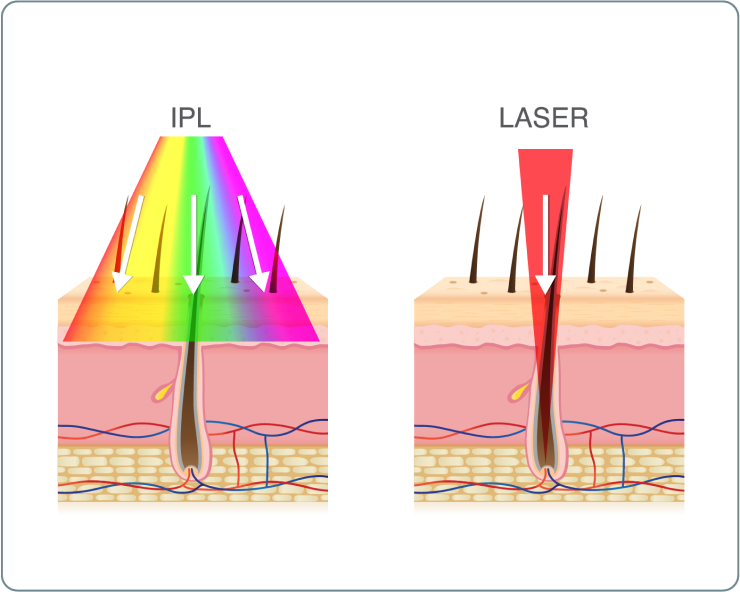 IPL Haarentfernung - Was ist der Unterschied zwischen einer IPL Haarentfernung und einer Laser Haarentfernung?