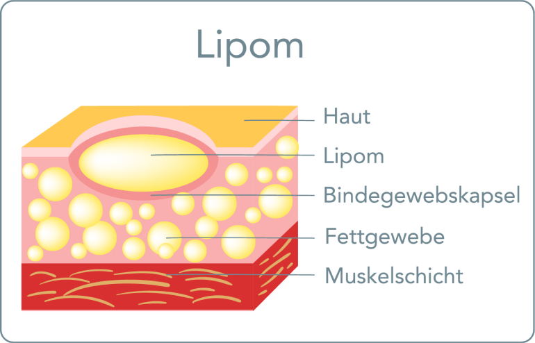 Lipom - Liposuktion (Fettabsaugung)