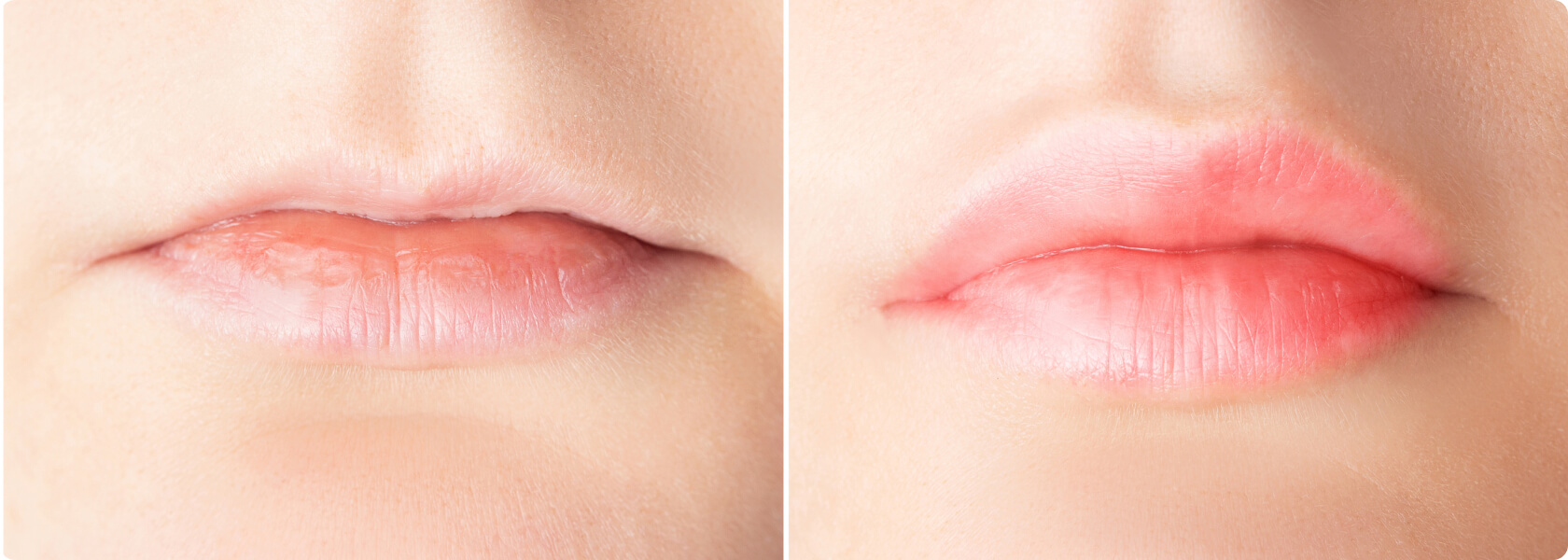 Lippen aufspritzen (Lippenvergrößerung) - Was versteht die Medizin unter dem Lippen aufspritzen?
