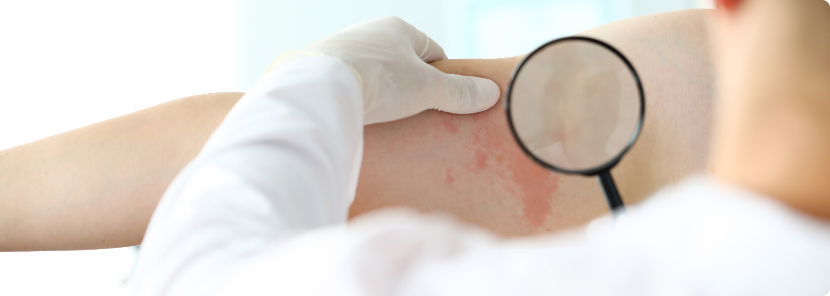 Dermatitis - Je nach Ursache des Ekzems können neben der Hauterkrankung auch weitere Krankheitssymptome wie Fieber
